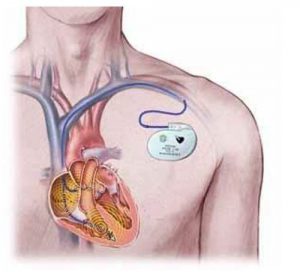 طرح توجیهی تولید دستگاه محرک ماهیچه قلب